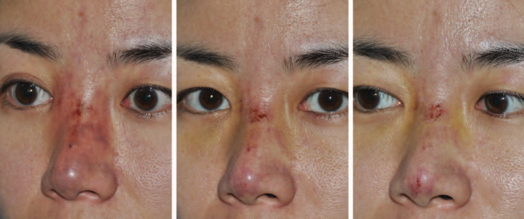 필러 I Clinical Outcomes of Impending 2