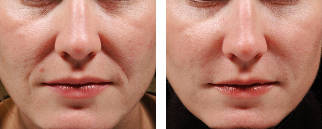 필러 I Dermal Fillers Bare Body Shop 2