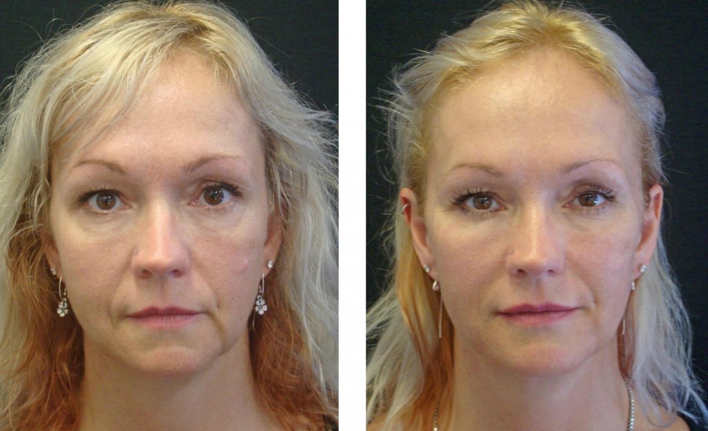 필러 I Dermal Fillers Brisbane 2