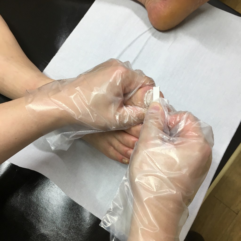 발톱무좀 I 네일라카 시작