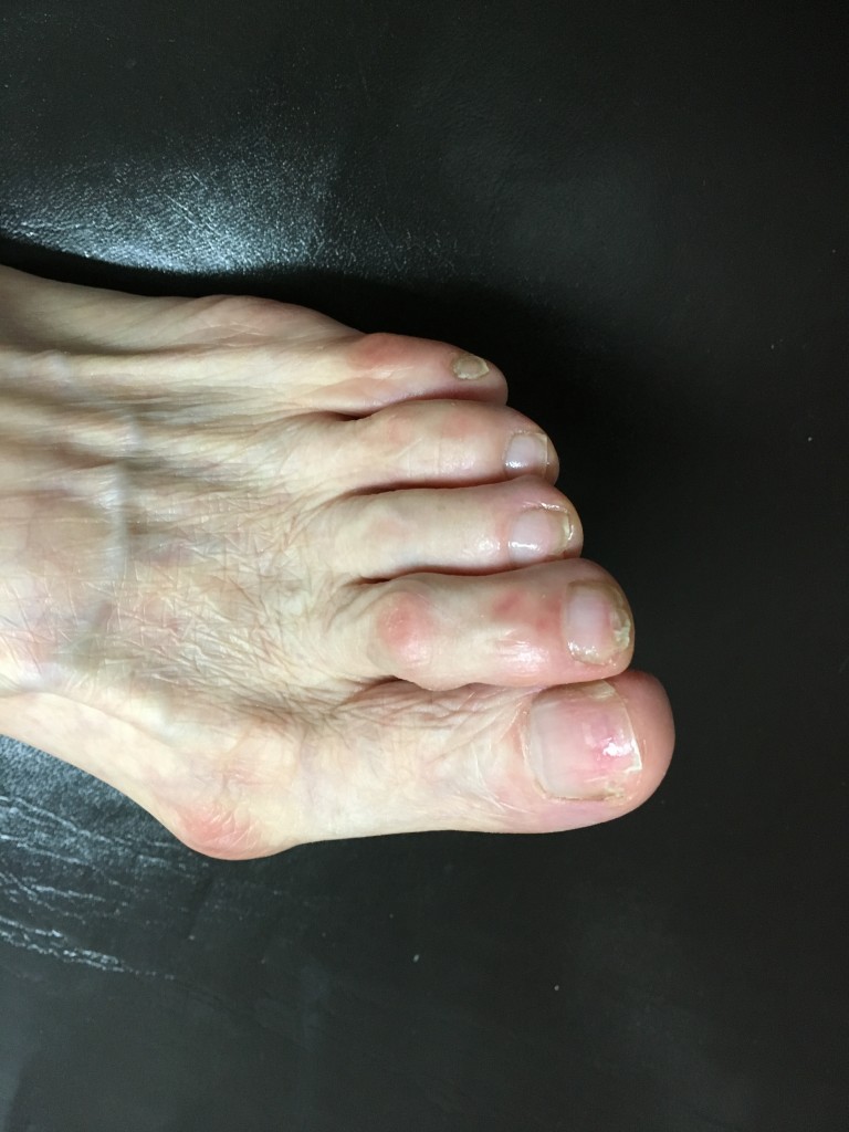 발톱무좀 I 라카 이후 회전