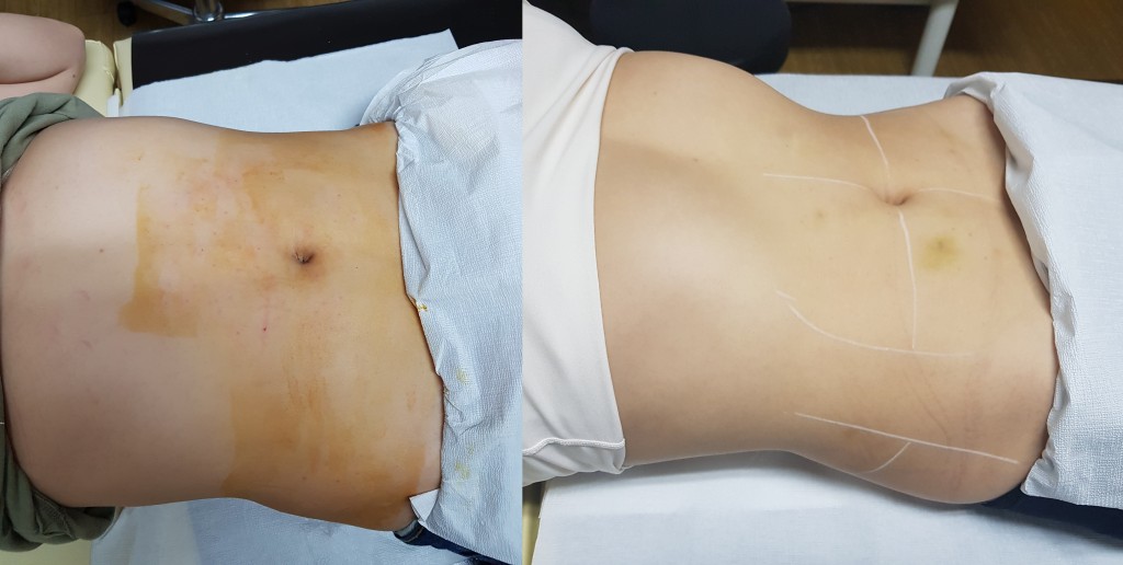 지방분해주사 메조 5_13 supine-horz