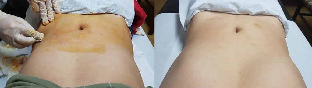 지방분해주사 메조 5_13 상하